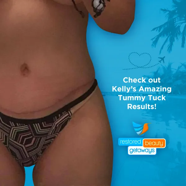 Kelly’s Tummy Tuck – Before & After