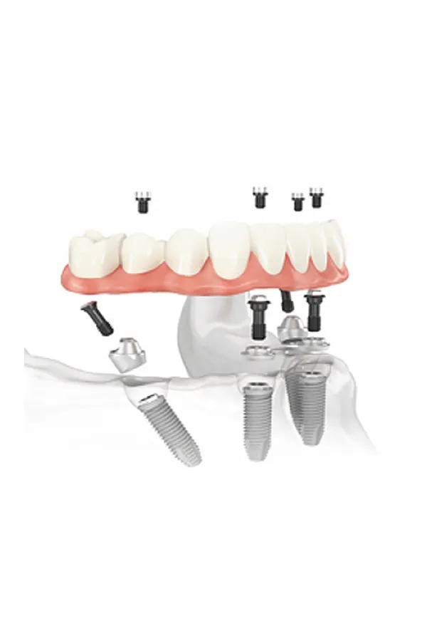 All-on-4 Dental Implants