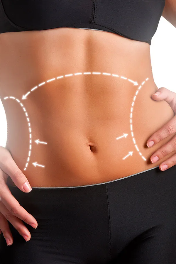 Belt Lipectomy Body Contouring