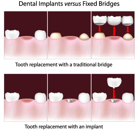 Dental bridges illustration