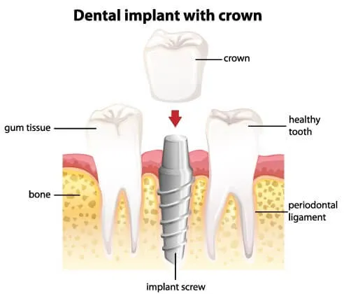 Dental implant structure illustration
