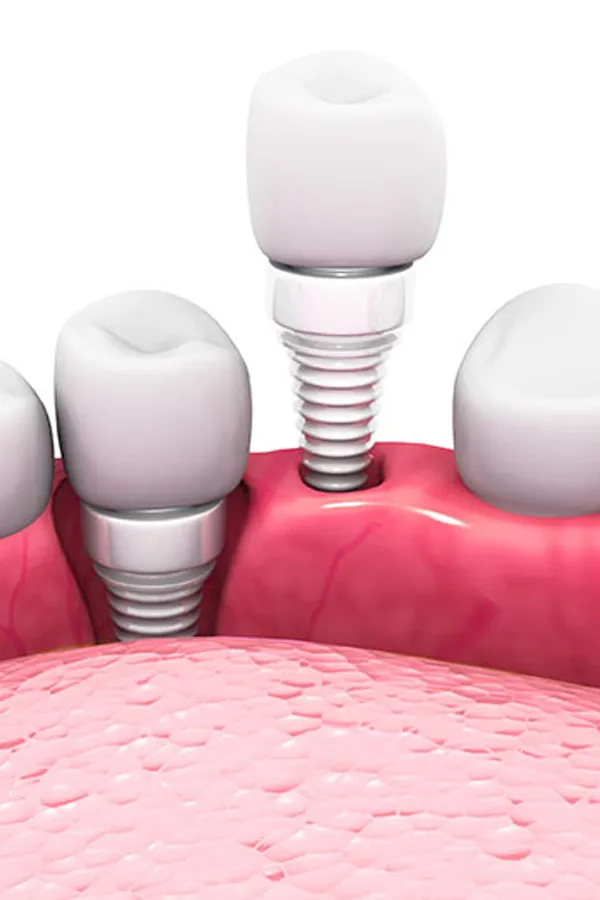 All-on-4 Dental Implants