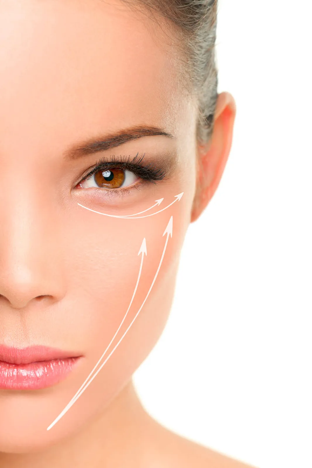 Facelift surgery
