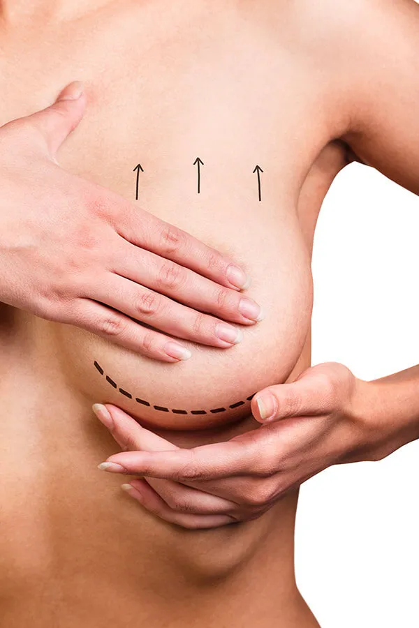 Breast Lift with Implants