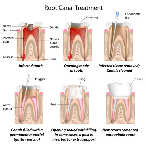 Root canal treatment illustration