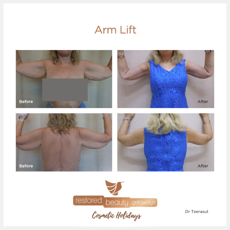 Upper Arm Lift Restored Beauty Getaways
