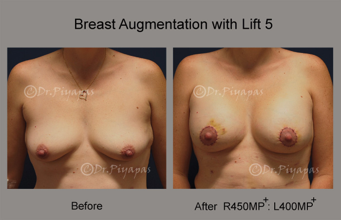 breast-augmentation-with-lift-11
