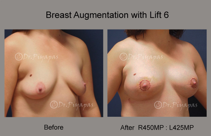 breast-augmentation-with-lift-14