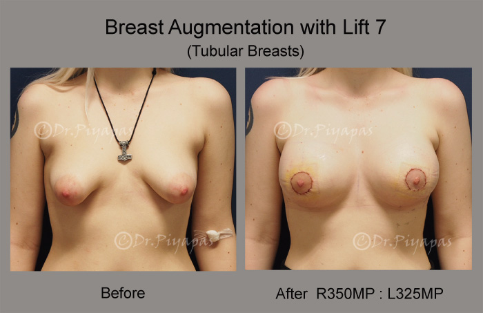 breast-augmentation-with-lift-15