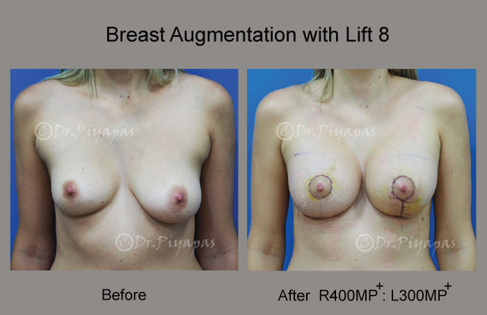 breast-augmentation-with-lift-17