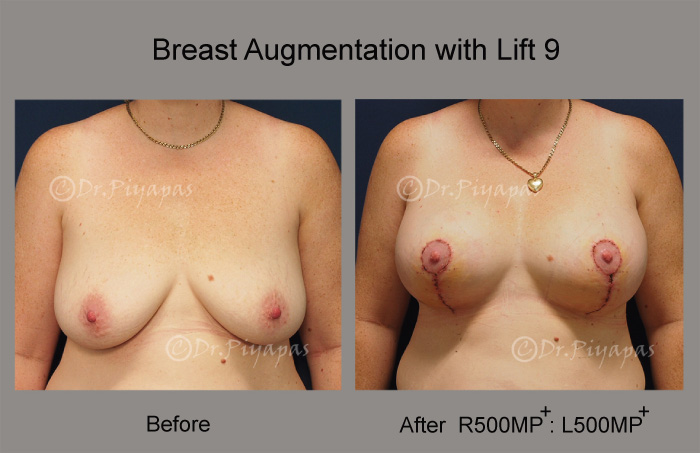 breast-augmentation-with-lift-19