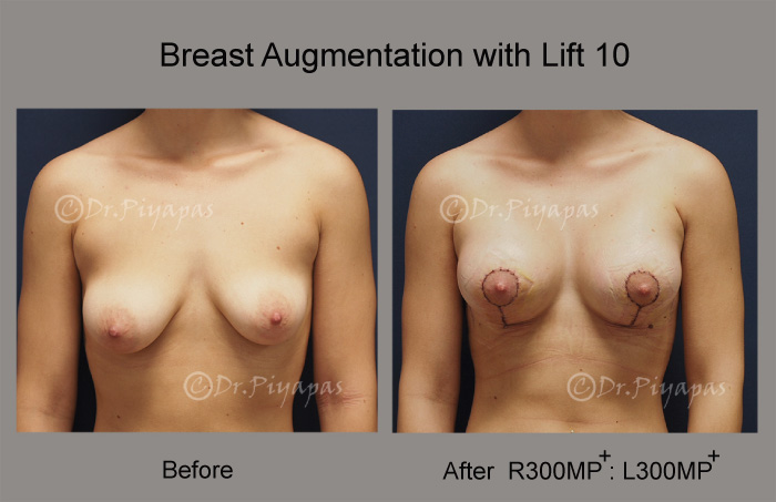 breast-augmentation-with-lift-21