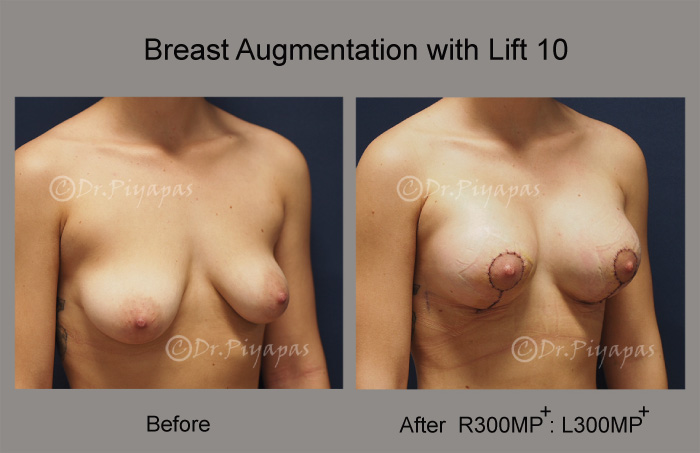 breast-augmentation-with-lift-22