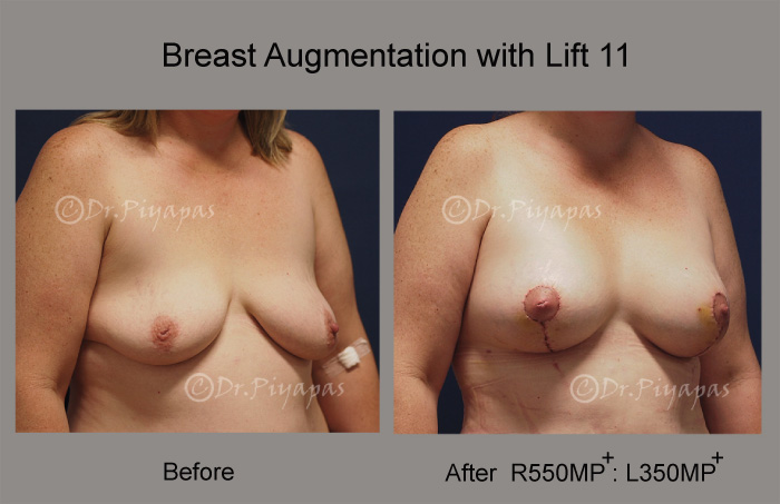 breast-augmentation-with-lift-24