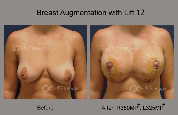breast-augmentation-with-lift-25