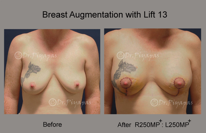 breast-augmentation-with-lift-27