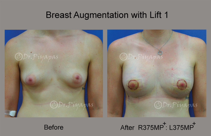 breast-augmentation-with-lift-3