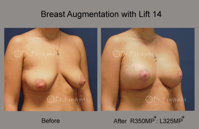 breast-augmentation-with-lift-30