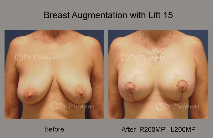 breast-augmentation-with-lift-31
