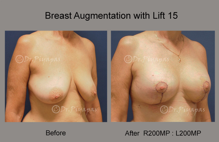 breast-augmentation-with-lift-32