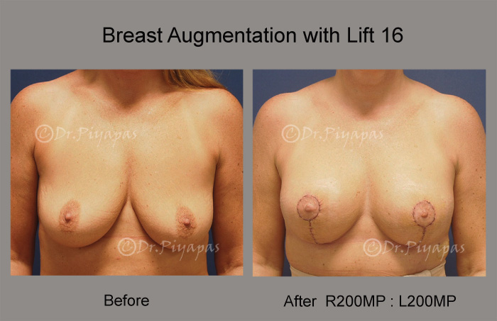 breast-augmentation-with-lift-33