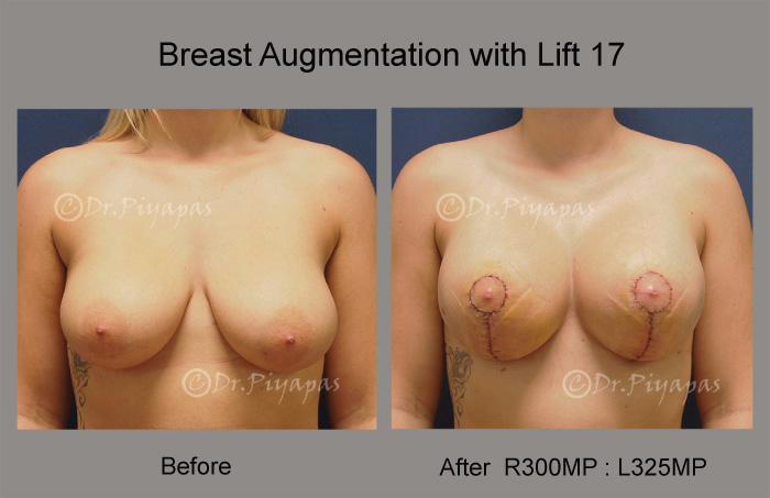 breast-augmentation-with-lift-35