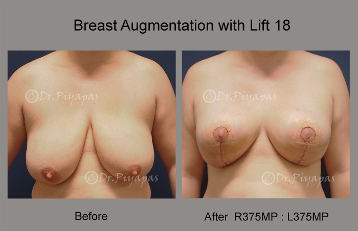 breast-augmentation-with-lift-37
