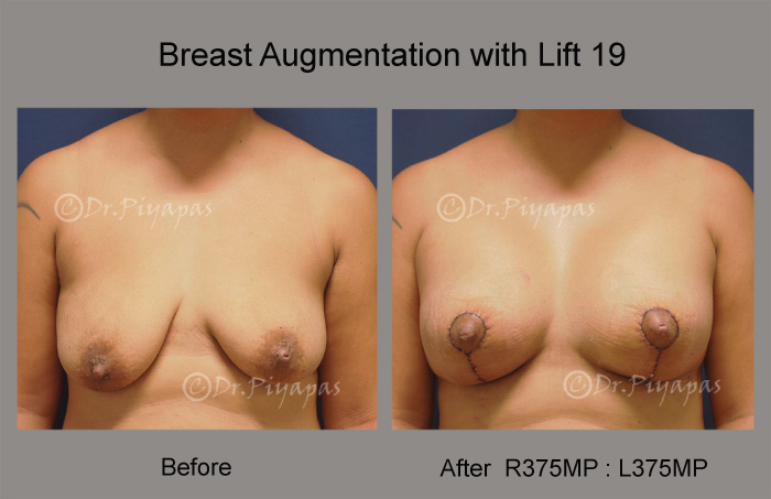breast-augmentation-with-lift-39
