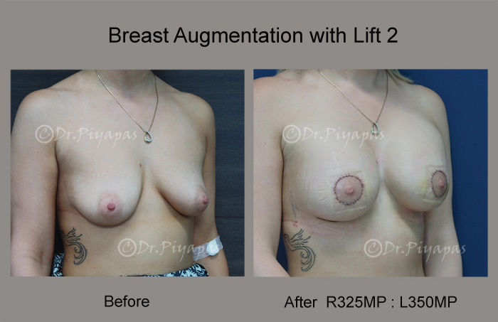 breast-augmentation-with-lift-6