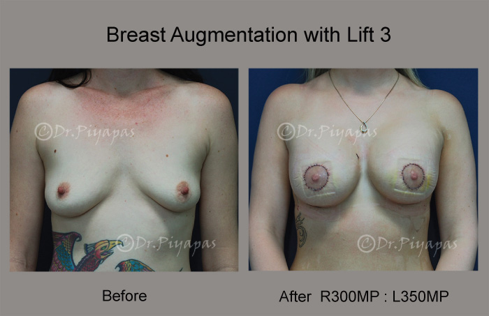 breast-augmentation-with-lift-7