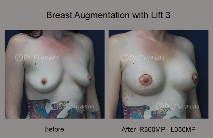 breast-augmentation-with-lift-8