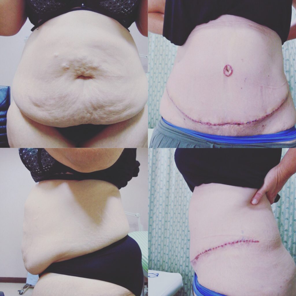 Tummy Tuck