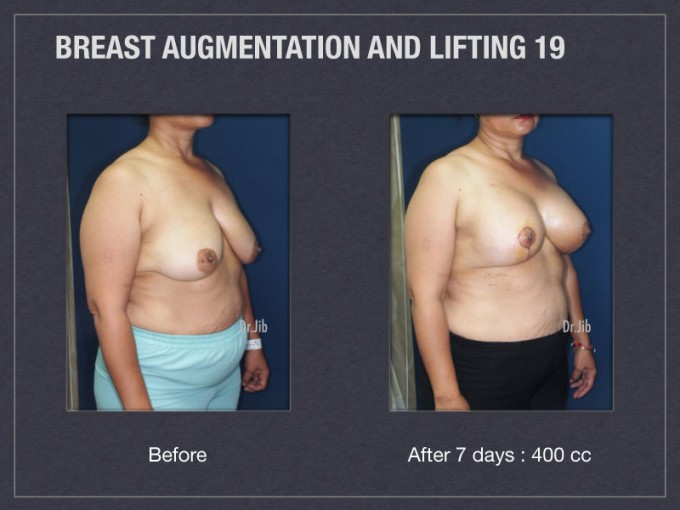 breast-augmentation-lift-38 - Restored Beauty Getaways