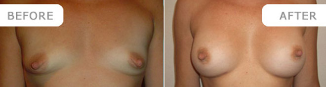 breastenlarge_13
