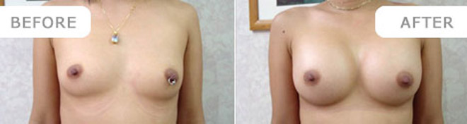 breastenlarge_9