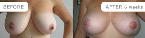 breastliftreduction_3