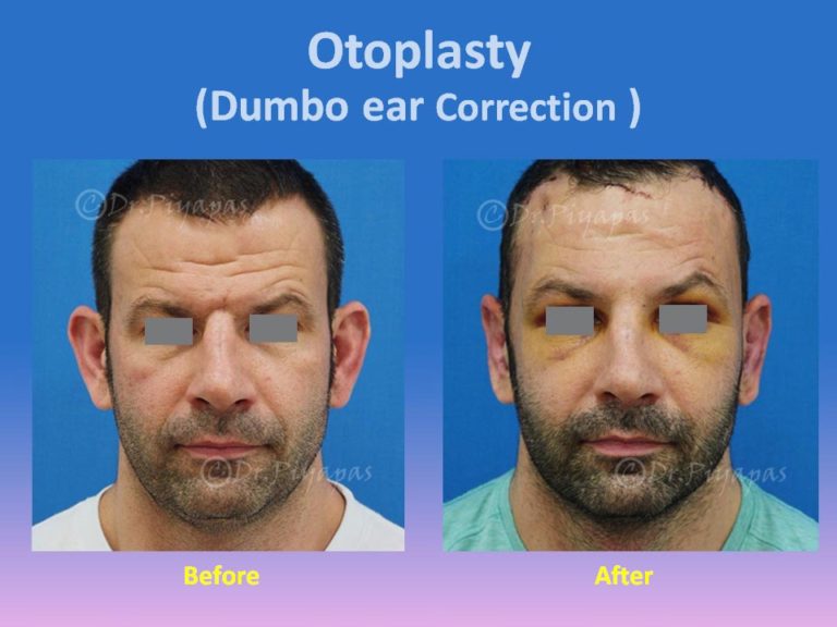 Bat Ear Correction Restored Beauty Getaways